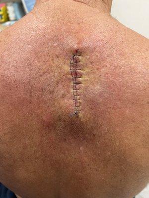 Melanoma removed