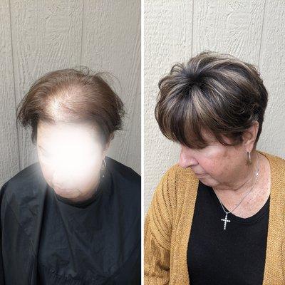 Non-Surgical Hair Replacement to enhance fullness, and confidence