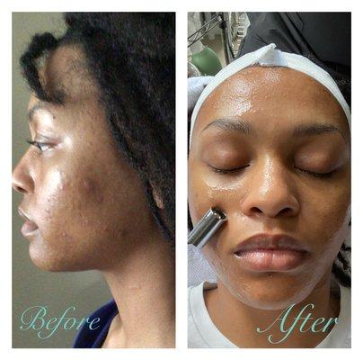 Acne Facial with Chemical Peel