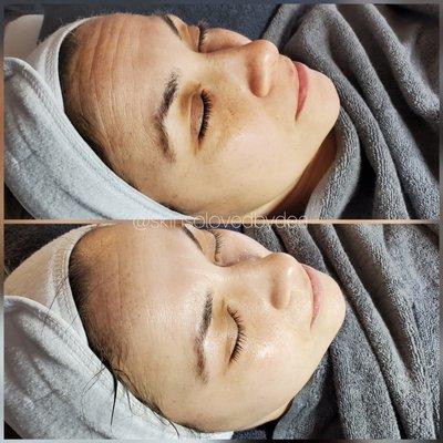 Fine lines minimized in just ONE facial service!! RADIO FREQUENCY LIFT!