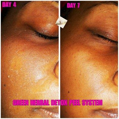 Green Herbal Peel Detox
-removes puffiness smooths complexion removes discoloration prevent breakouts natural peel system no harsh chemicals