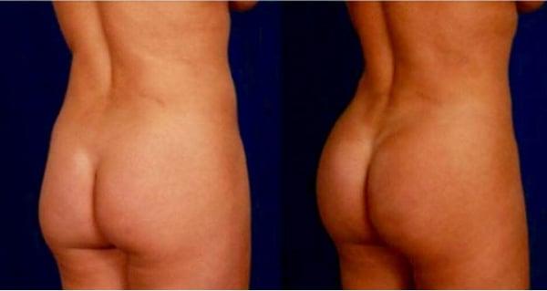 Brazilian Butt Lift (before and after)