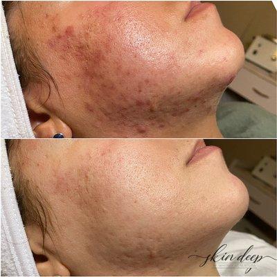 Acne program before & after