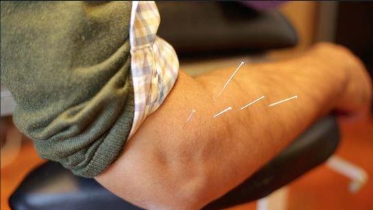 Acupuncture