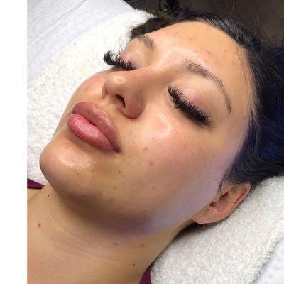 Platinum Immunity Hydrafacial