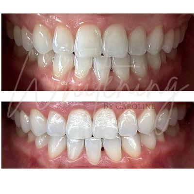 90 min professional teeth whitening