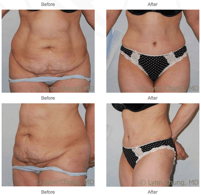 Tummy Tuck