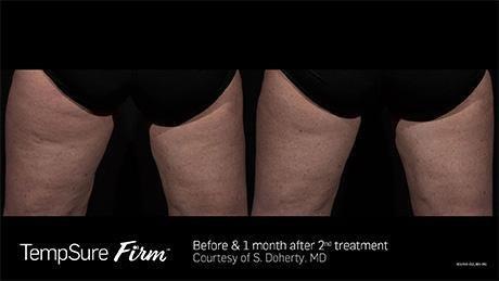 Cellulite Reduction with TempSure