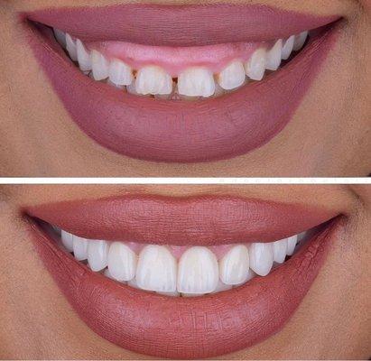 Laser gum lift and porcelain w