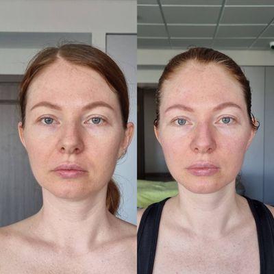 Before/after 1 treatment