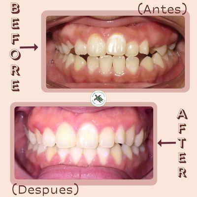 Smile Transformation Magic! 
Transformación Mágica de Sonrisa!