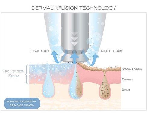 Dermalinfusion, 3-in-1 technology