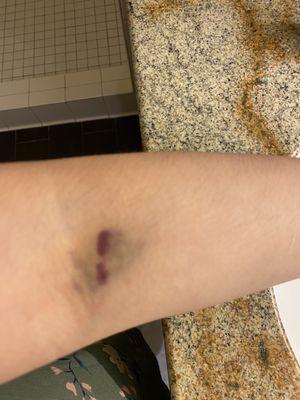 Right Arm Bruise