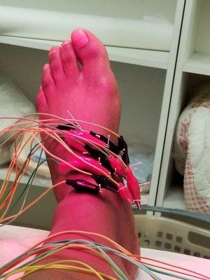 Left foot with needles and stimulation attached