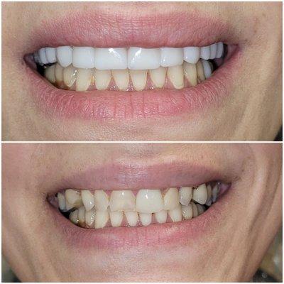 Full upper teeth and smile makeover. This patient had a big improvement in her smile with just the upper teeth done so far in only 2 visits