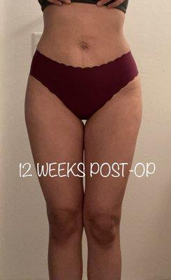 12 weeks post-op front