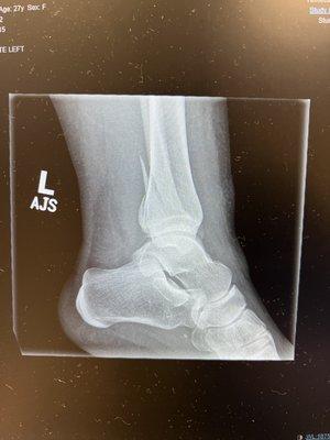 My supposedly "possible fractured fibula" as if I'm making it up?? I fucking wish I was, because this group is a joke.