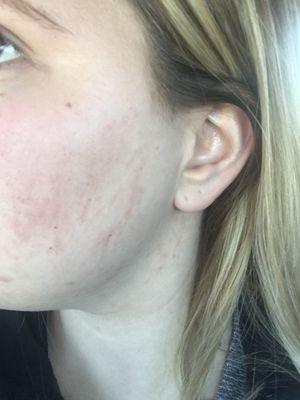 Dermaplaning scratched my face