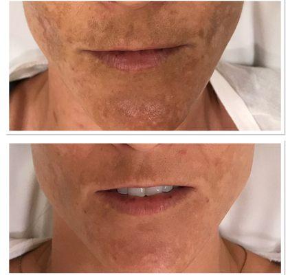 Before and after pictures from microneedling.