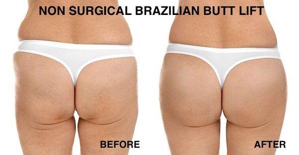 Non Surgical Brazilian Butt Lift