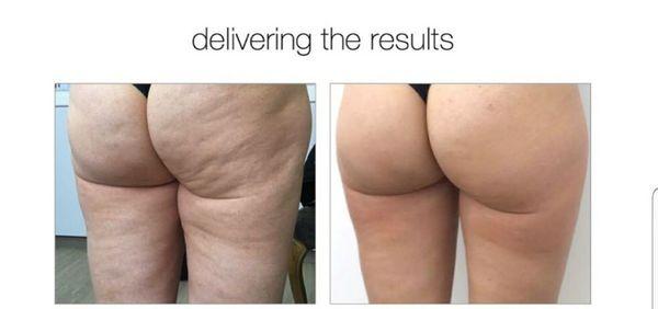 butt lifting and tightening also cellulite treatment.