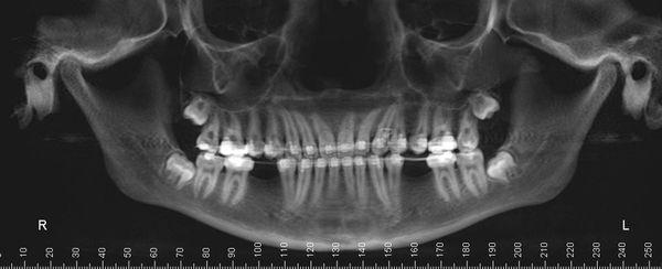 Before- Xray Adult with missing teeth.