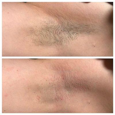 Before and after of a first time underarm waxer! Smooth and clean.