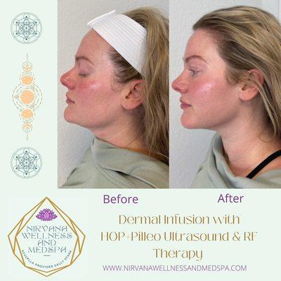 Dermal Infusion with HOP+Pilleo, utilizes stem cells and PLLA Filler to rejuvenate the face, neck and décolleté!