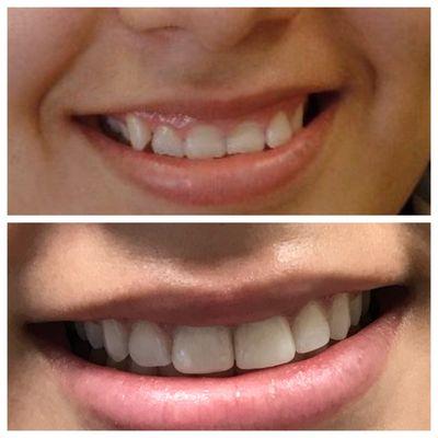 top: original smile bottom: smile after invisalign with 2 cosmetic crowns on the front 2 teeth, and bonding on the outer 2 teeth.