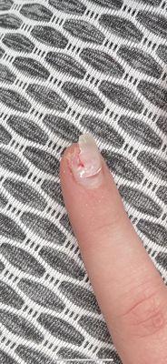 Bleeding nail.