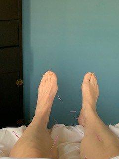 Leg points-acupuncture by Storm.