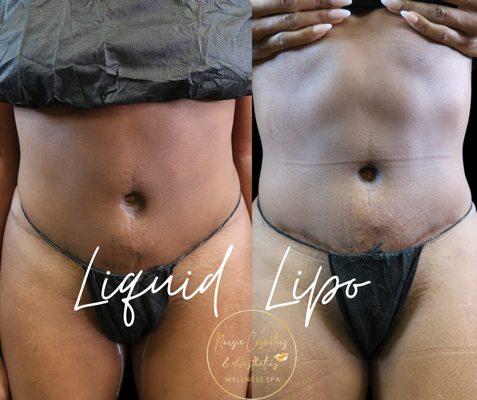 Liquid Lipo- Nonsurgical 2 sessions minimum recommended