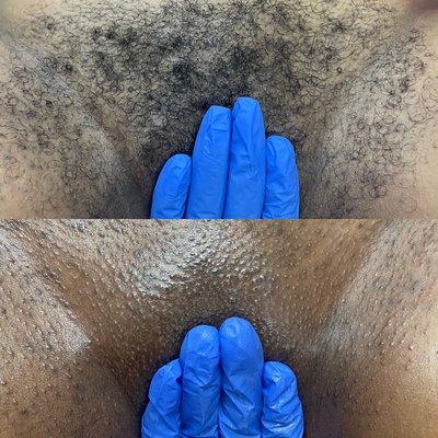 Before and after Brazilian wax