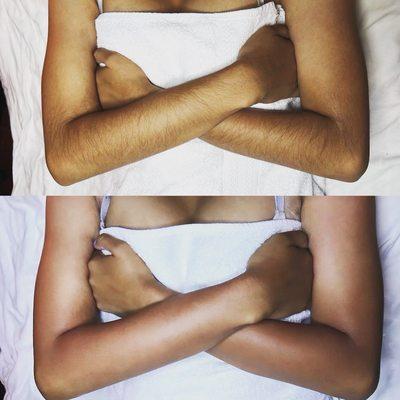 Arm Sugaring before & after