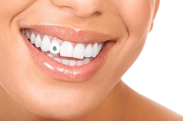 We offer cosmetic dental gem services.