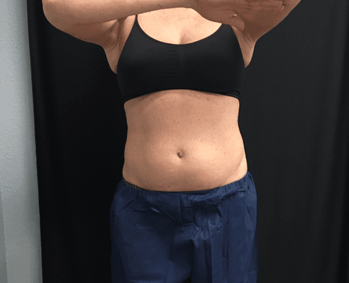 CoolSculpting abdomen and flanks BEFORE