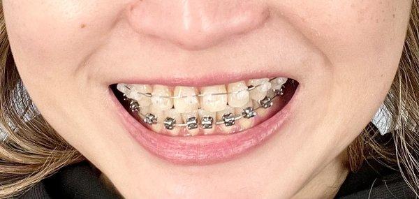 Damon braces with clear on the top