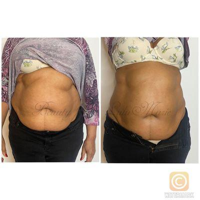 Results after 1 of our 360 láser lipo treatments! These Are Same Day Results! Client lost 5 inches on her 1st Treatment.