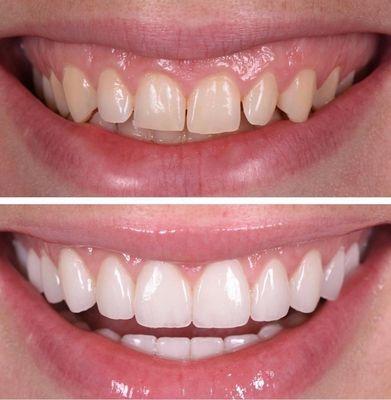 Porcelain veneers and laser gum lift