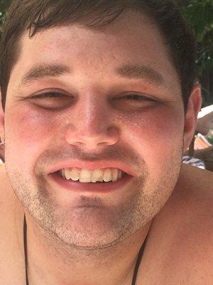 The before, I chipped my tooth in Thailand on my honeymoon.