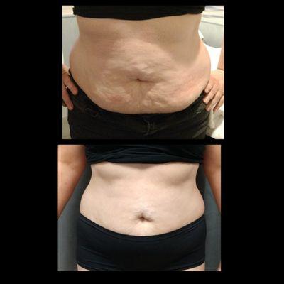 Cryoskin body contouring