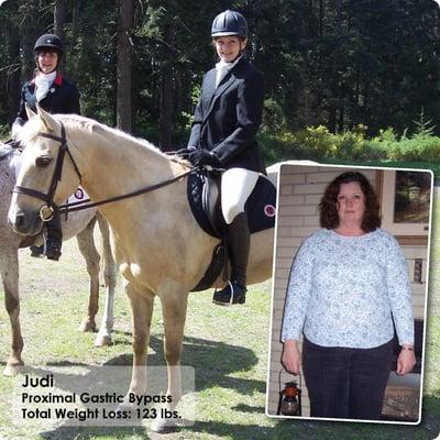 Judi lost 123 lbs. after having the Proximal Gastric Bypass with Dr. Srikanth.