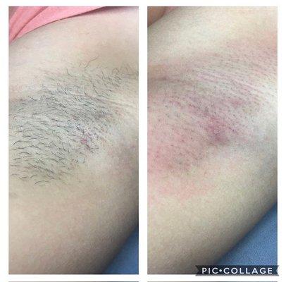 Axilla (armpit) hair removal.