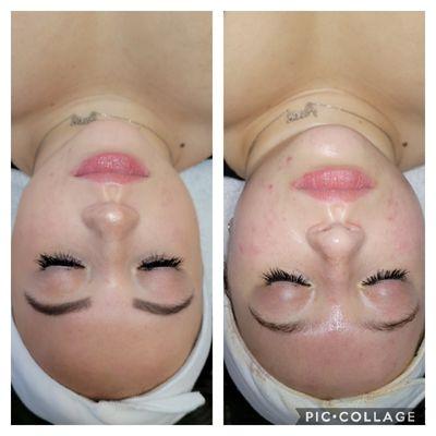 Before and after galvanic treatment