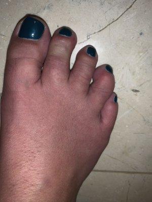 Bacterial infection from pedicure 11/13/2020