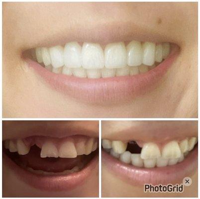 Upper teeth crowns