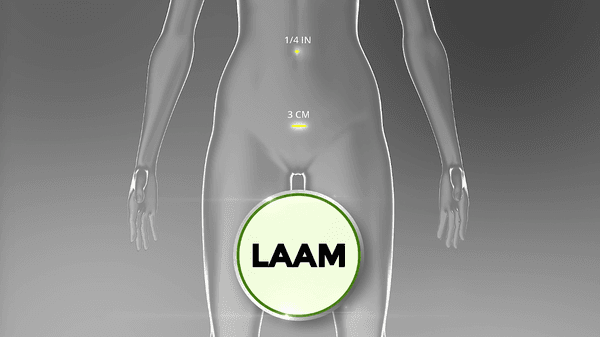 The innovative LAAM approach is used at CIGC to perform laparoscopic myomectomy. Learn more: https://innovativegyn.com/techniques/laam/