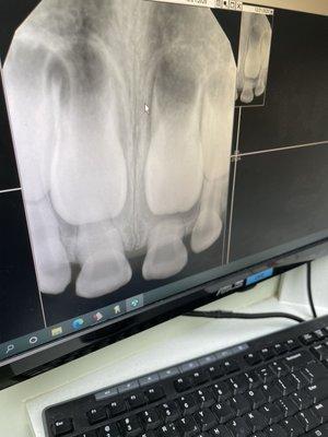 His first dental X-ray. You can see the adult teeth!