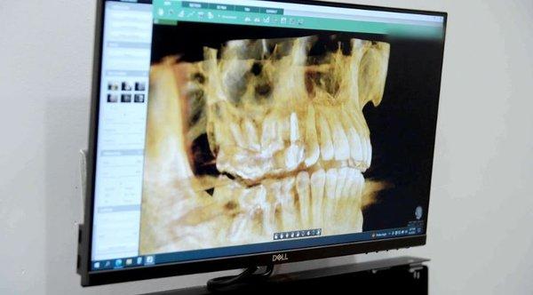 CT Scan technology for Implant placements and Endodontic treatment