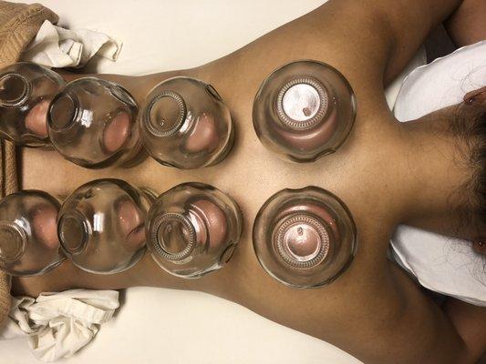 Cupping Therapy Now Offered At Renewed Spirit Massage & Bodyworks!! Cupping Releases Toxins and improves Joint/Tissue Mobility!!